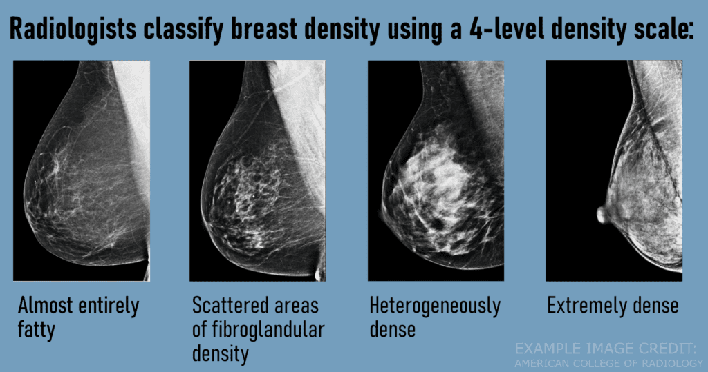 Breast Imaging - Big Sky Diagnostic Imaging
